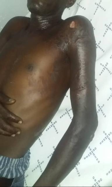 NKURENKURU, 23 June 2025- A 48-year-old man was hospitalized after suffering severe burns in a domestic violence incident at Mayara village, Kavango West region, on Sunday.

(Photo: Contributed)
NAMPA