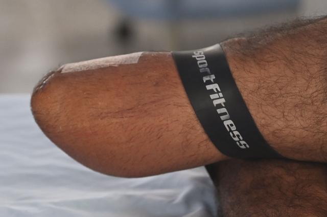 A sport fitness band is pictured on the mutilated leg of Army soldier Oscar Vasquez, who lost his leg to a landmine in Tumaco on October 2025, at the Army Rehabilitation Centre in Bogota on December 11, 2025. The Humanitarian De-mining Battalion was created with the purpose of clearing landmines placed by different criminal groups during the 60 years of drug powered Colombian internal conflict. (Photo by Daniel MUNOZ / AFP)