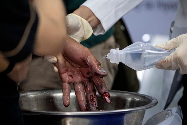 (FILES) A person injured by firecrackers is cared for at the Jose Reyes Memorial Medical Center in Manila early on January 1, 2019, after New Year's celebrations. Police have been raising awareness of the dangers of firecrackers and fireworks among young people in the Bas-Rhin in view of New Year's Eve, when firecrackers and rockets will explode and whistle in the city and in the countryside where they are a landmark tradition. (Photo by NOEL CELIS / AFP)