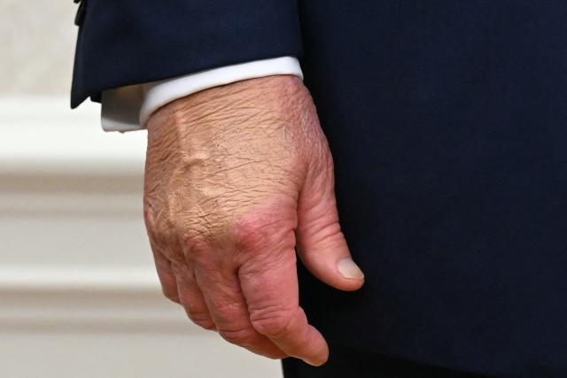 (FILES) A close-up shows US President Donald Trump's right hand after he announced a deal on drug pricing at the Oval Office of the White House in Washington, DC, on October 10, 2025. Trump blamed aspirin for large bruises on his hand and denied falling asleep while attending public meetings in an interview with The Wall Street Journal published on January 1, 2026. In the interview defending his health, Trump also changed his previous statement about receiving an MRI scan in October, saying it was instead a quicker CT scan. (Photo by SAUL LOEB / AFP)