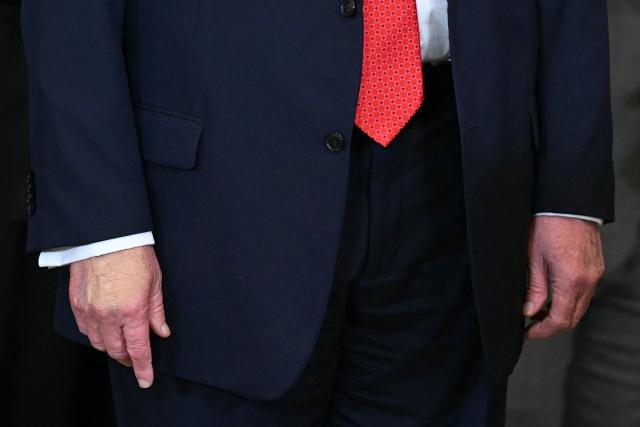 (FILES) A close-up shows US President Donald Trump's hands as he greets the college baseball teams of Louisiana State University (LSU) and LSU Shreveport, winners of this year College World Series and the National Championships, respectively, at the White House in Washington, DC, on October 20, 2025. Trump blamed aspirin for large bruises on his hand and denied falling asleep while attending public meetings in an interview with The Wall Street Journal published on January 1, 2026. In the interview defending his health, Trump also changed his previous statement about receiving an MRI scan in October, saying it was instead a quicker CT scan. (Photo by SAUL LOEB / AFP)