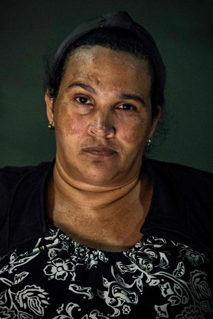 Huntington’s patient Jennifer Barboza poses for a picture during a medical examination at a volunteer medical clinic in the neighborhood of San Luis in Maracaibo, Zulia state, Venezuela, on January 30, 2026. The Lake Maracaibo region in Venezuela holds the world’s highest concentration of Huntington’s disease (HD), with a prevalence of roughly 700 per 100,000 in certain areas. (Photo by Maryorin Mendez / AFP)