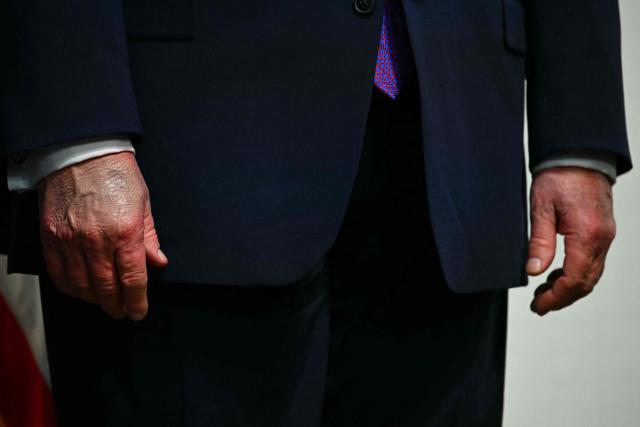The hands of US President Donald Trump are seen at a healthcare affordability event in the South Court Auditorium of The White House in Washington, DC, on May 18, 2026. (Photo by Kent NISHIMURA / AFP)