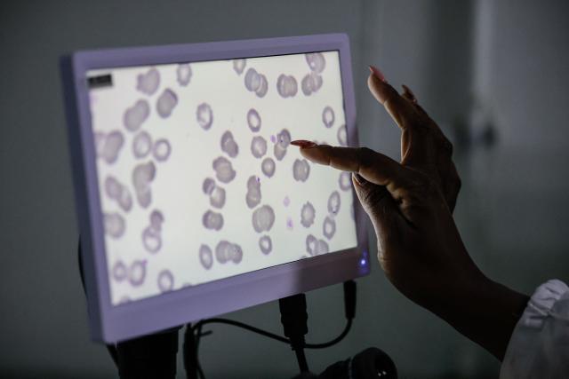 Medical technologist and laboratory manager at the National Health Laboratory Service Rirhandzu Mashale points to a malaria-positive blood sample projected from a microscope at Tintswalo Hospital in Bushbuckridge on May 26, 2026. Human-induced climate change, compounded by the La Nina weather pattern, has intensified extreme rainfall across southern Africa, the National Institute for Communicable Diseases (NICD) said, creating conditions that can fuel malaria transmission long after floodwaters recede.
In Mpumalanga, cases rose fourfold in January compared with a year earlier, jeopardising South Africa's goal of eliminating malaria by 2029. (Photo by EMMANUEL CROSET / AFP)