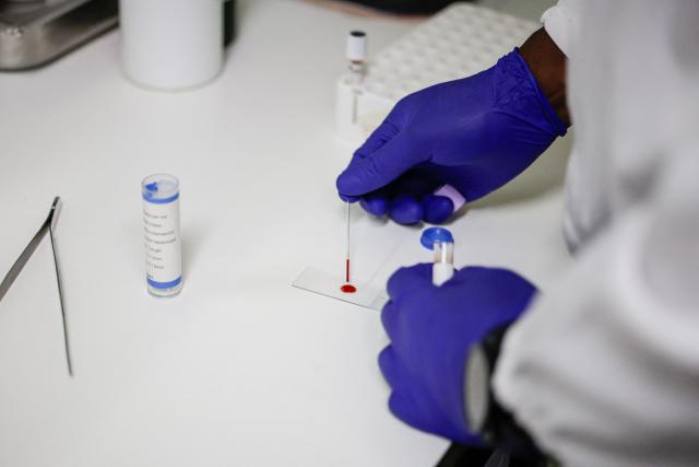 Medical technologist and laboratory manager at the National Health Laboratory Service Rirhandzu Mashale places a drop of blood on a slide before having it examined malaria at Tintswalo Hospital in Bushbuckridge on May 26, 2026. Human-induced climate change, compounded by the La Nina weather pattern, has intensified extreme rainfall across southern Africa, the National Institute for Communicable Diseases (NICD) said, creating conditions that can fuel malaria transmission long after floodwaters recede.
In Mpumalanga, cases rose fourfold in January compared with a year earlier, jeopardising South Africa's goal of eliminating malaria by 2029. (Photo by EMMANUEL CROSET / AFP)