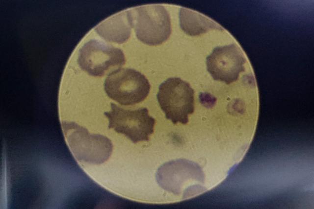 A malaria-positive blood smear is seen through a microscope in the National Health Laboratory at Tintswalo Hospital in Bushbuckridge on May 26, 2026. Human-induced climate change, compounded by the La Nina weather pattern, has intensified extreme rainfall across southern Africa, the National Institute for Communicable Diseases (NICD) said, creating conditions that can fuel malaria transmission long after floodwaters recede.
In Mpumalanga, cases rose fourfold in January compared with a year earlier, jeopardising South Africa's goal of eliminating malaria by 2029. (Photo by EMMANUEL CROSET / AFP)