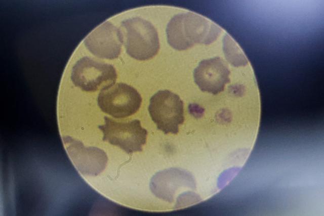 A malaria-positive blood smear is seen through a microscope in the National Health Laboratory at Tintswalo Hospital in Bushbuckridge on May 26, 2026. Human-induced climate change, compounded by the La Nina weather pattern, has intensified extreme rainfall across southern Africa, the National Institute for Communicable Diseases (NICD) said, creating conditions that can fuel malaria transmission long after floodwaters recede.
In Mpumalanga, cases rose fourfold in January compared with a year earlier, jeopardising South Africa's goal of eliminating malaria by 2029. (Photo by EMMANUEL CROSET / AFP)