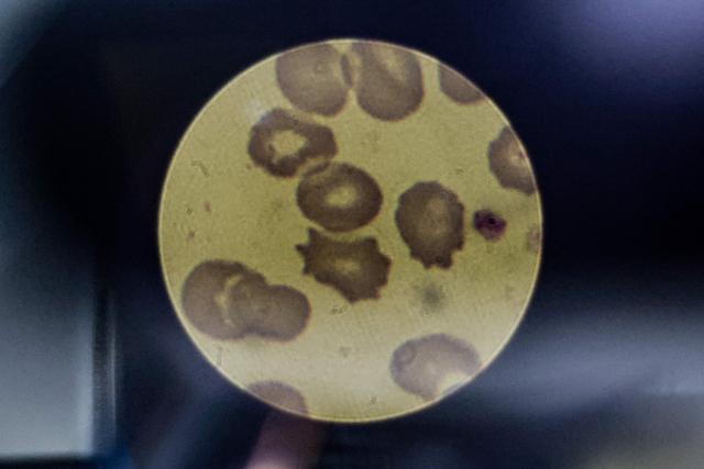 A malaria-positive blood smear is seen through a microscope in the National Health Laboratory at Tintswalo Hospital in Bushbuckridge on May 26, 2026. Human-induced climate change, compounded by the La Nina weather pattern, has intensified extreme rainfall across southern Africa, the National Institute for Communicable Diseases (NICD) said, creating conditions that can fuel malaria transmission long after floodwaters recede.
In Mpumalanga, cases rose fourfold in January compared with a year earlier, jeopardising South Africa's goal of eliminating malaria by 2029. (Photo by EMMANUEL CROSET / AFP)