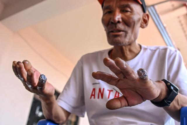 Everest survivor Dawa Sherpa shows his frostbitten hands during an interview with AFP in Kathmandu on June 18, 2026. (Photo by Prakash MATHEMA / AFP)