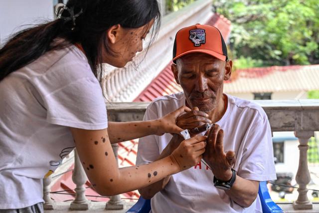 Everest survivor Dawa Sherpa's daughter Mendo Lhamu Sherpa (L) applies ointment on his frostbitten hands in Kathmandu on June 18, 2026. (Photo by Prakash MATHEMA / AFP)