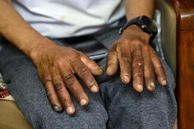 Everest survivor Dawa Sherpa shows his frostbitten hands during an interview with AFP in Kathmandu on June 18, 2026. (Photo by Prakash MATHEMA / AFP)