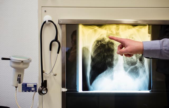 FILED - 23 February 2016, Berlin: A doctor shows a tuberculosis case using an X-ray in his office at the tuberculosis center. Photo: Gregor Fischer/Deutsche Presse-Agentur GmbH/dpa