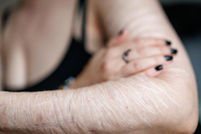 FILED - 10 October 2024, Bavaria, Nuremberg: A victim of self-harming behaviour shows scars on her arm. Photo: Daniel Karmann/dpa