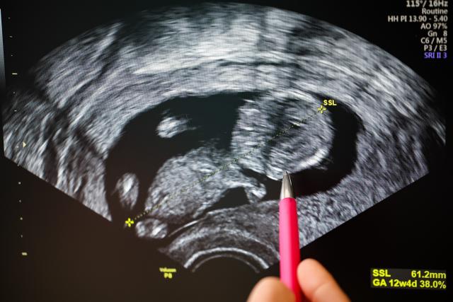 FILED - 17 April 2024, Saxony-Anhalt, Bitterfeld-Wolfen: FILE PHOTO - A gynecologist points to the head of a fetus in the ultrasound image. Photo: Jan Woitas/dpa