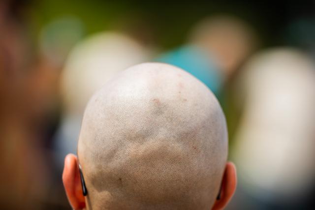 18 July 2026, Berlin: A participant takes part in the "Berlin Bald Festival" in Goerlitzer Park in Berlin. The programme includes games, contests and group activities, with the highlight being an attempt to set a record for the largest gathering of bald people. Photo: Christoph Soeder/dpa
