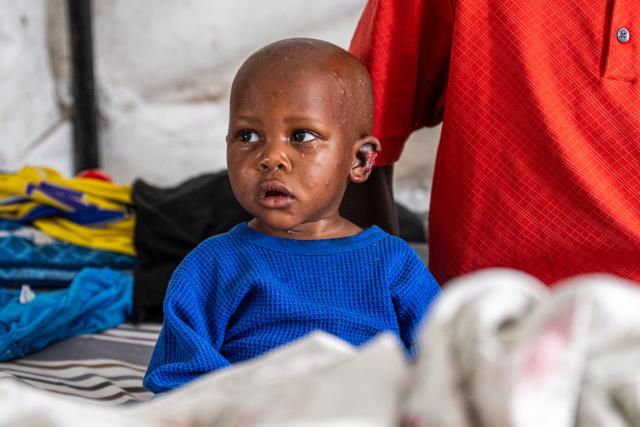 (250511) -- GOMA, May 11, 2025 (Xinhua) -- A child with an ear injury caused by the local conflict is seen at Ndosho Hospital in Goma, the Democratic Republic of the Congo (DRC), on May 10, 2025. Ndosho Hospital, located in Goma, the capital city of North Kivu province in the eastern DRC, has built temporary tents in its parking lot to relieve pressure and increased its bed capacity to approximately 130, as the security situation in the eastern DRC has deteriorated in recent years. (Xinhua/Zheng Yangzi)