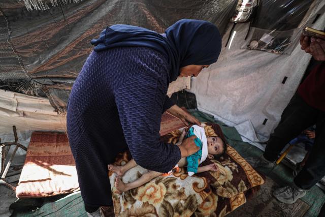 (250529) -- GAZA, May 29, 2025 (Xinhua) -- This photo taken on May 28, 2025 shows a child suffering from severe malnutrition at a camp for displaced people, west of Gaza City. (Photo by Mahmoud Zaki/Xinhua)