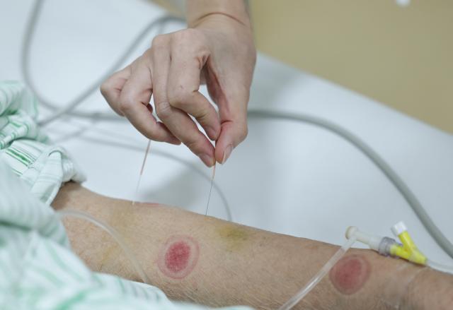 (260214) -- BEIJING, Feb. 14, 2026 (Xinhua) -- At 9:14 a.m. on Feb. 9, 2026: doctor Li Qiong provides acupuncture treatment to an inpatient in the Emergency Department in Guang'anmen Hospital in Beijing, capital of China. With the Spring Festival just around the corner, the staff members at the Emergency Department of Guang'anmen Hospital remain on duty around the clock. Racing against time, they are fully committed to protect the health of patients.
   As a national-level emergency center which integrates Traditional Chinese Medicine and Western medicine, the Emergency Department of Guang'anmen Hospital was founded over 40 years ago. Generations of medical practitioners have carried forward the wisdom of Traditional Chinese Medicine while keeping pace with modern emergency rescue. They are not only proficient in using advanced emergency equipment such as Extracorporeal Membrane Oxygenation (ECMO) and ultrasound diagnostic instruments to rescue critically ill patients, but also provide patients with precise and effective characteristic diagnosis and treatment, featuring over 30 hospital-agreed prescriptions and more than 20 external treatment methods of Traditional Chinese Medicine. (Xinhua/Zhang Yuwei)