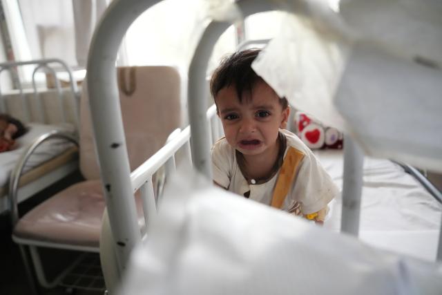 (260713) -- KABUL, July 13, 2026 (Xinhua) -- A malnourished child is pictured at the Indira Gandhi Institute of Child Health in Kabul, Afghanistan, July 13, 2026. The UN Children's Fund (UNICEF) has raised the alarm that 3.7 million children under the age of 5 in Afghanistan are at heightened risk of malnutrition, according to a new report issued on Sunday. (Photo by Saifurahman Safi/Xinhua)